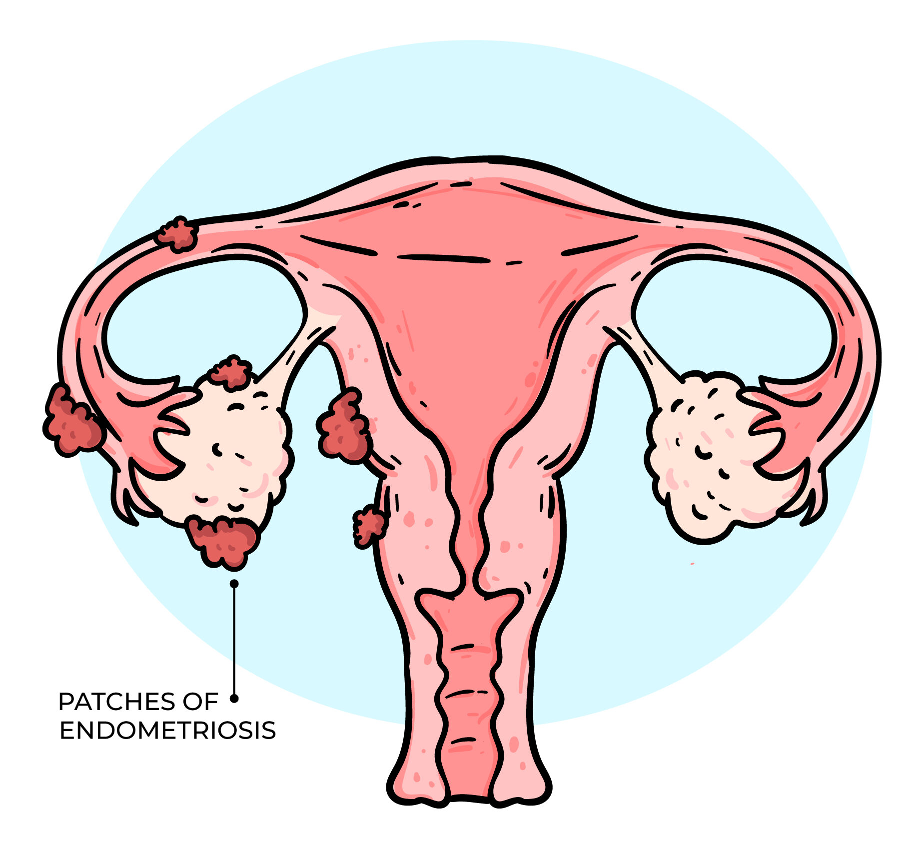 The Psychological Impact Of Endometriosis What You Need To Know