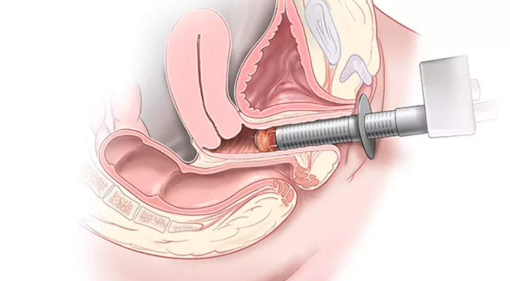 Find Laser Vaginal Rejuvenation Treament In Balewadi